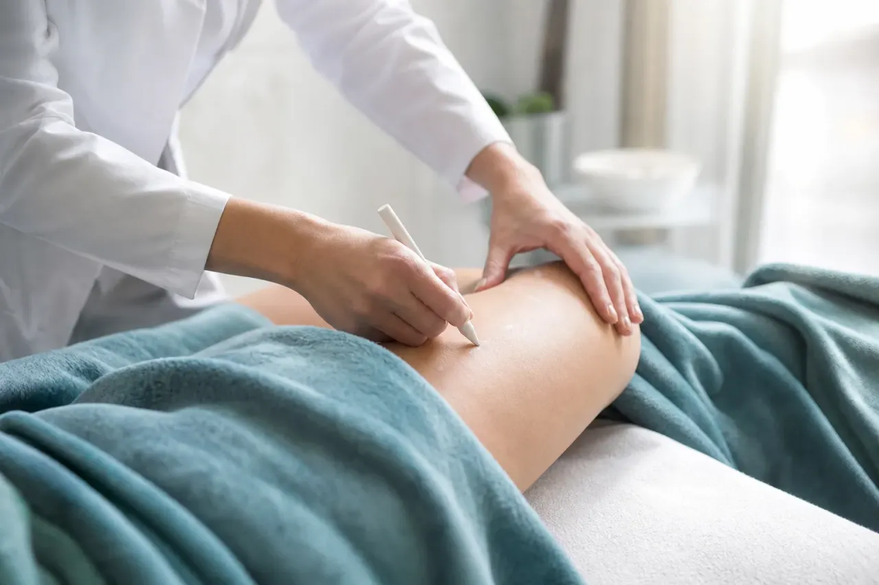 Mani di un medico che segnano i punti di valutazione sulla coscia con una matita dermografica
